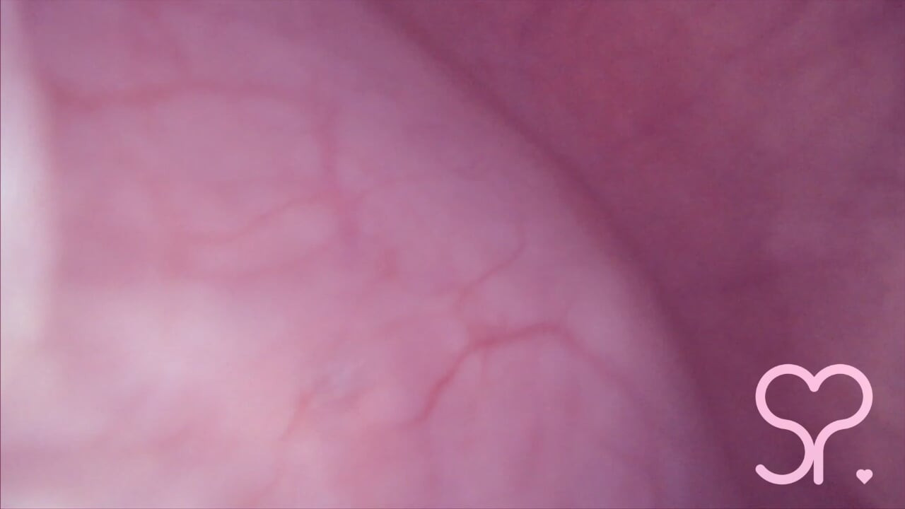 Bulge INSIDE my Bladder from Anal