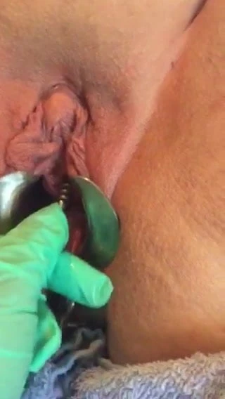 urethral sounding ribbed sound