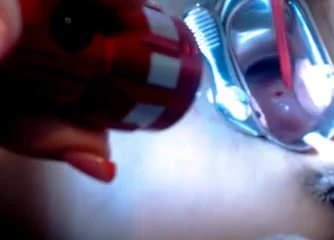 Cervix 4