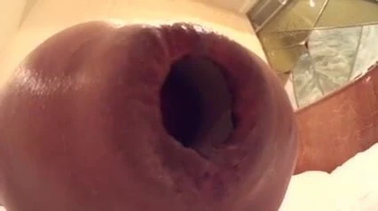 bulged anus