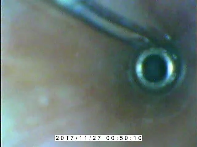 Endoscope E-stim inside Cumming.AVI