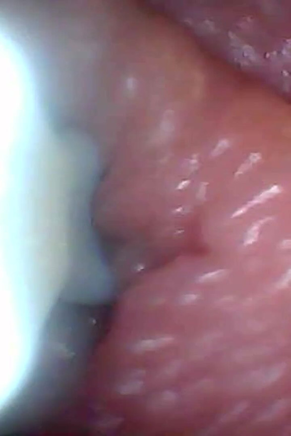 Endoscope Camera Shows the Most Sensitive Parts of the Penis Educational Video