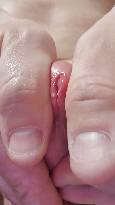 Extremely stretched hole after dilator play