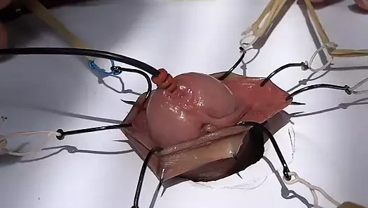 fishhooks in foreskin