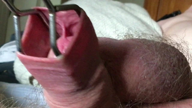 Tongs and highlighter in foreskin