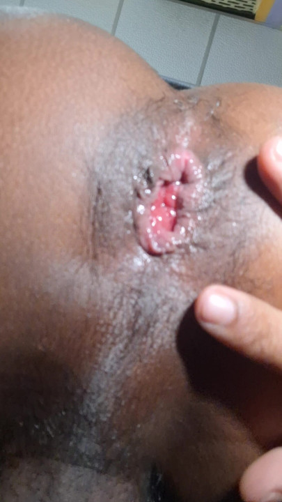 Start prolapse training Indian Boy