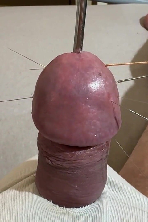 Kaedah akupunktur terbaik!