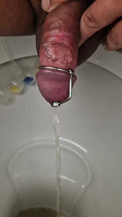 확장기로 방광 비우기