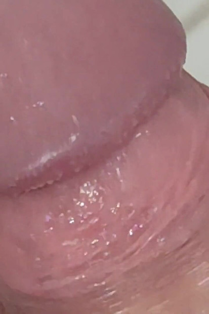 Extreme Burning Sensation Makes the Glans Foam with Arousal.