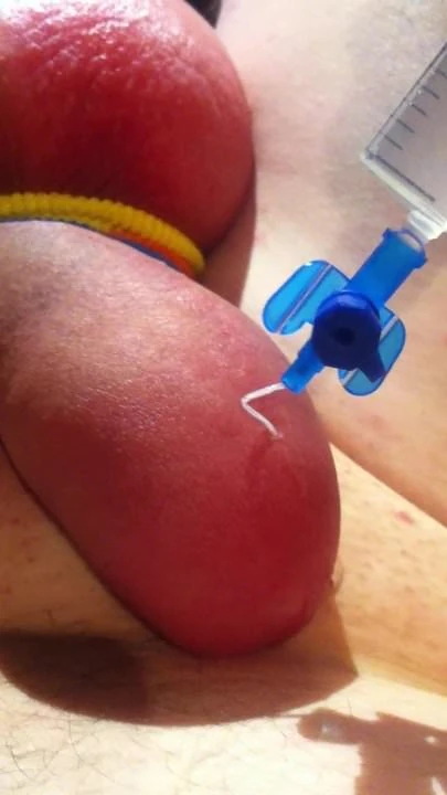 foreskin saline inflation