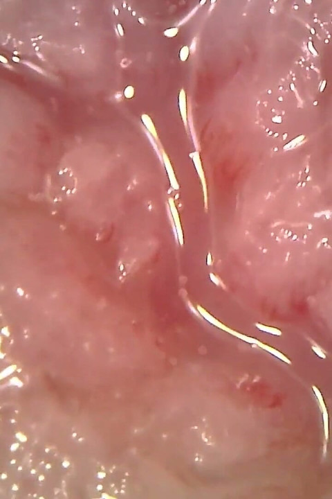 의료 내시경 구강 검사: 거미, 극단적 인 치아 및 혀 마크