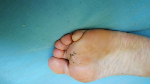 soles and toes