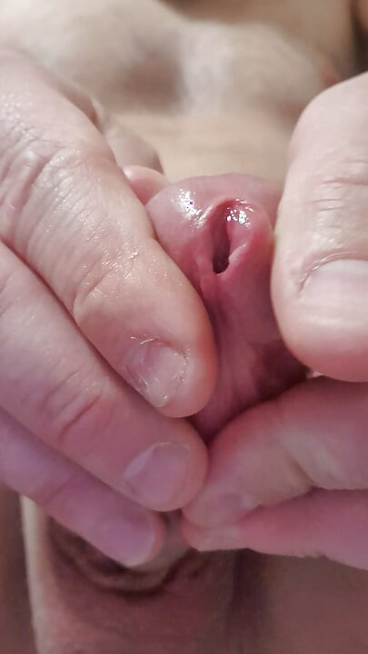 Extremely stretched hole after dilator play