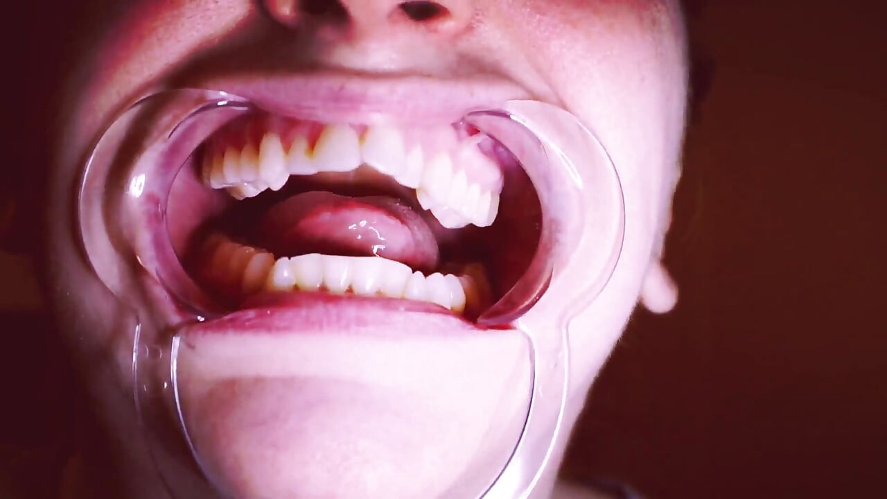 Preparing for Invisible Aligners