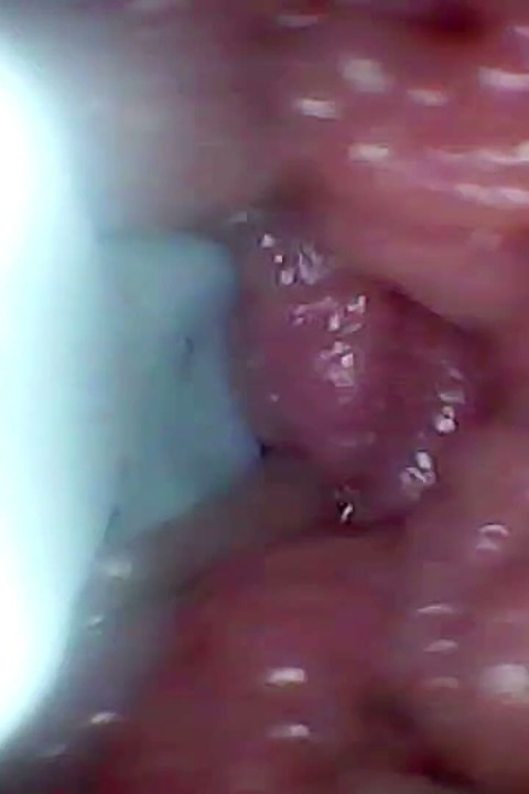 La Cámara De Endoscopio Graba El Punto G De Mi Esposa. Video Educativo De Cerca