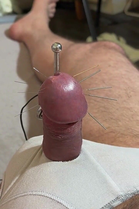 The Best Acupuncture Method!