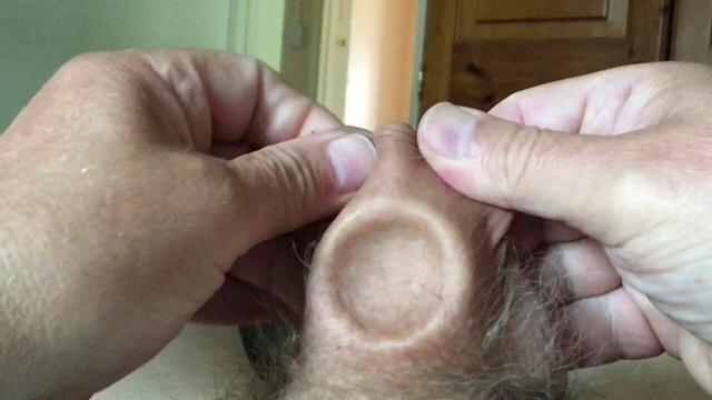 Candle holder in foreskin