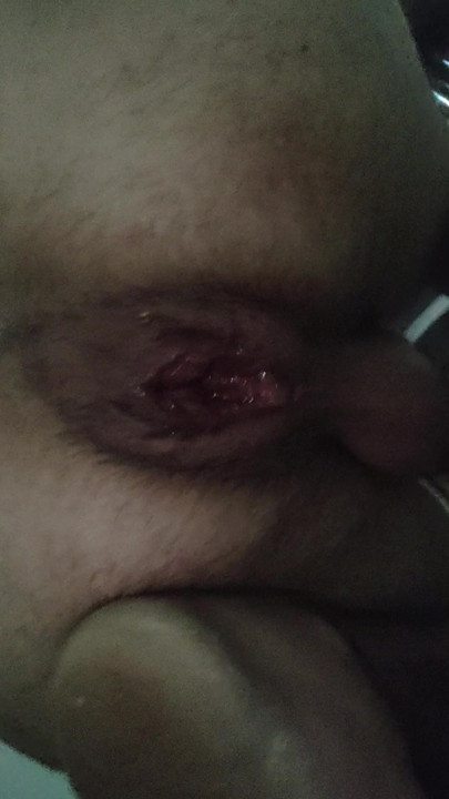Anal escaldado