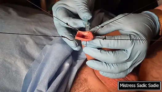 Needle CBT at It's Finest.