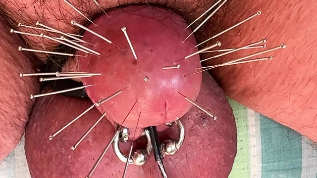Extreme glans - Acupuncture