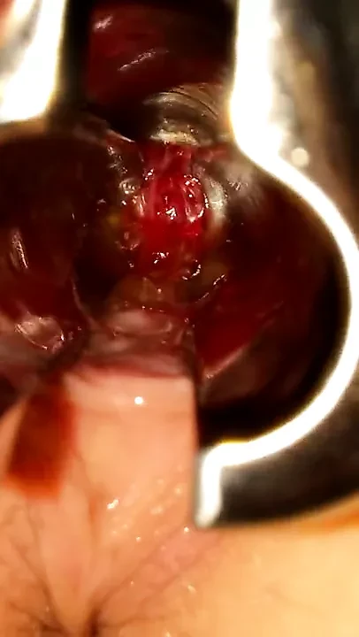 Take a look inside my bladder...