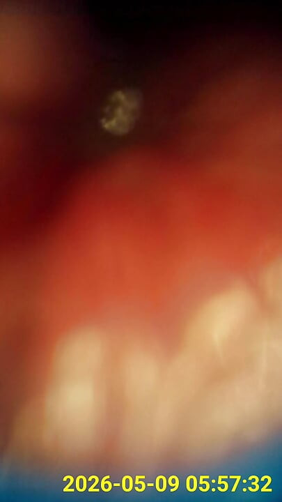 Close up of buttplug & HD Endoscope insertion