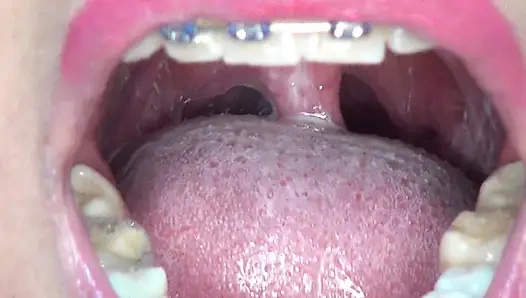 Ich Schlucke Ununterbrochen Große, Riesige Mandeln!!