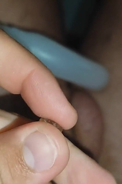 用射液器通过的极端切口.