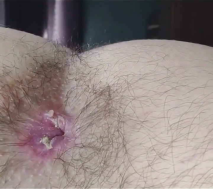 My Hairy Anus