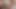 傷跡のためのDpダはCh1をしましょう