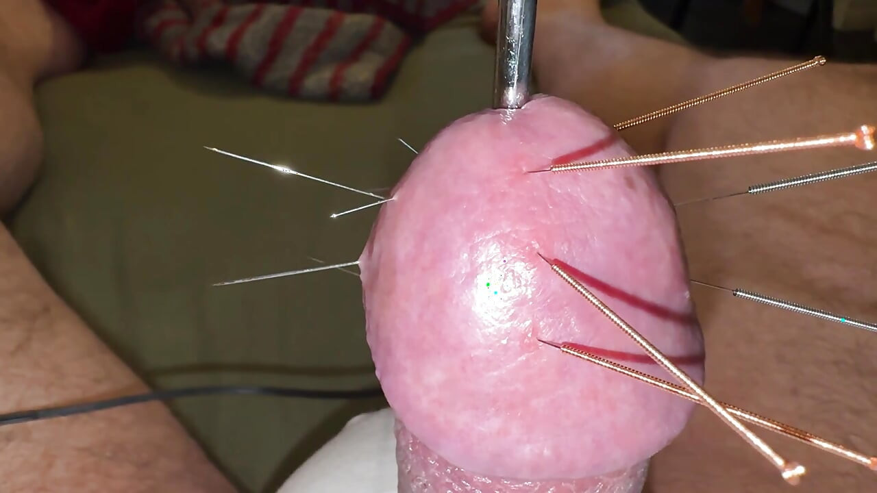 Acupuncture - Orgasm!