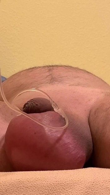 情感时刻从 "盐水输液 2 升"