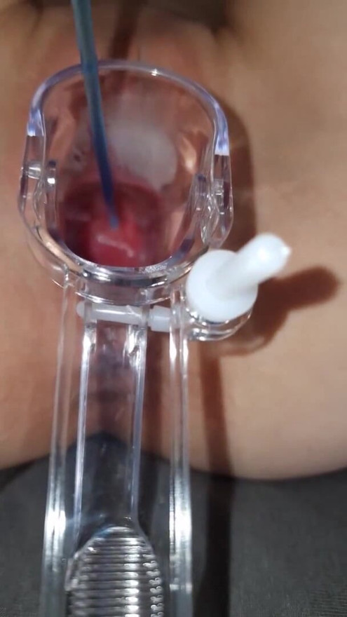Sperm directly into the uterus | Clip 1