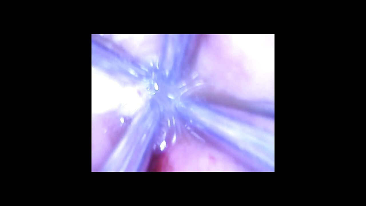 ספקולום ומיקרו-מצלמה עבור ליידי סוניאק