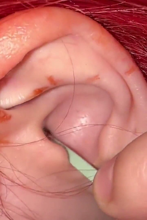 Cleaning Ear Wax