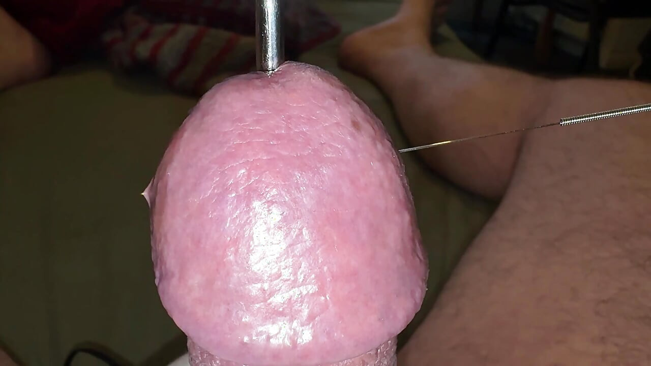 针灸——高潮!