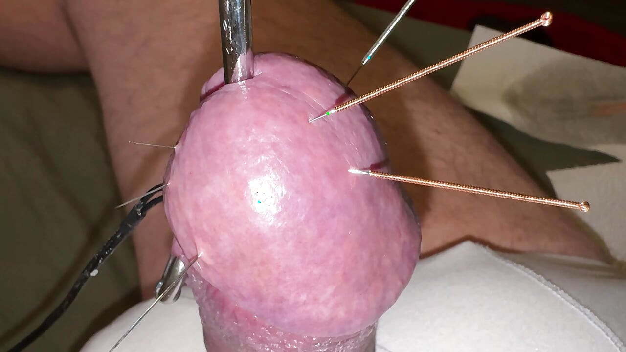 ¡acupuntura - ¡orgasmo!