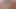 Foreskin in bath - 20 minutes