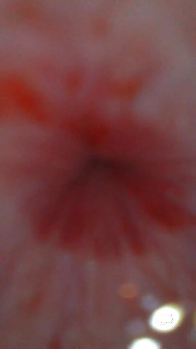 Endoscope from urethral opening to bladder