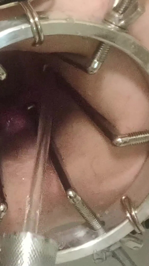 Enema, anal shower. Close-up view through anal mirror. Anal with water. Filling anal with water | Clip 1