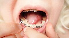 戴牙套的第二天 - 牙线 - 特写嘴巴之旅