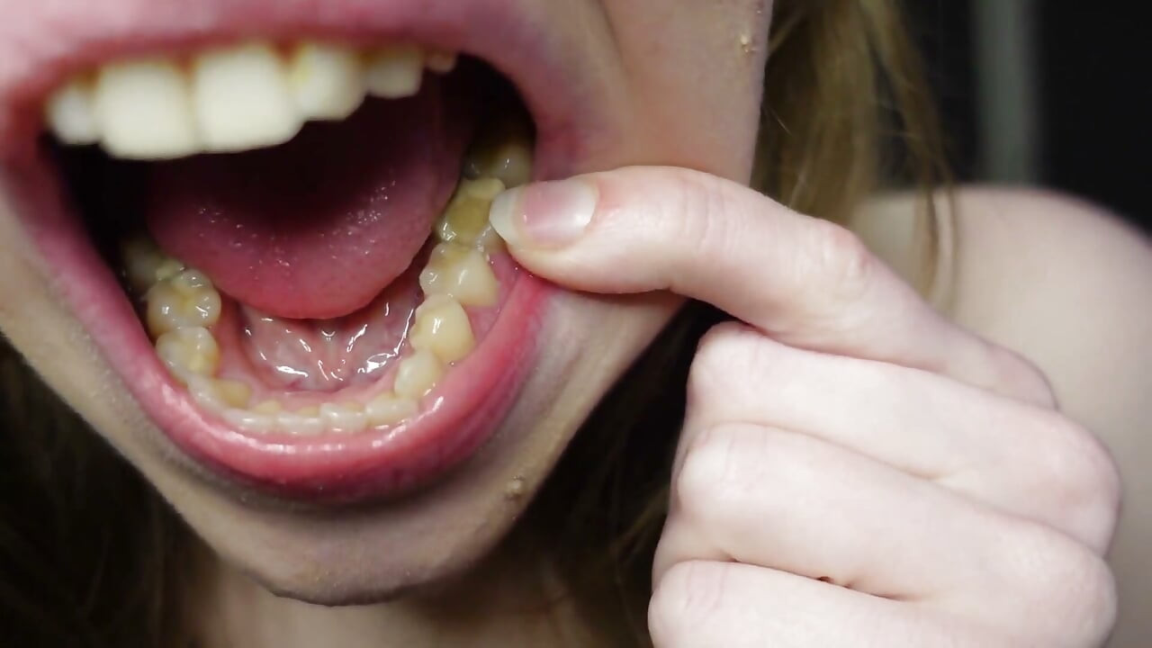 Eu Te Conto Sobre as Obturações Nos Meus Dentes E Visitas Odontológicas