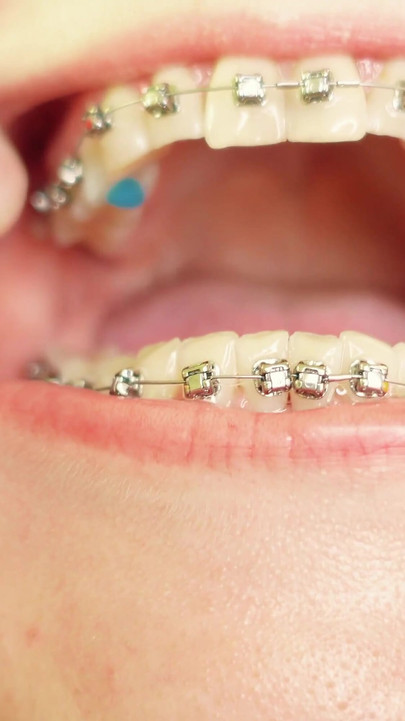 Iconic moment from "eating in braces - vore and food fetish - close up video"