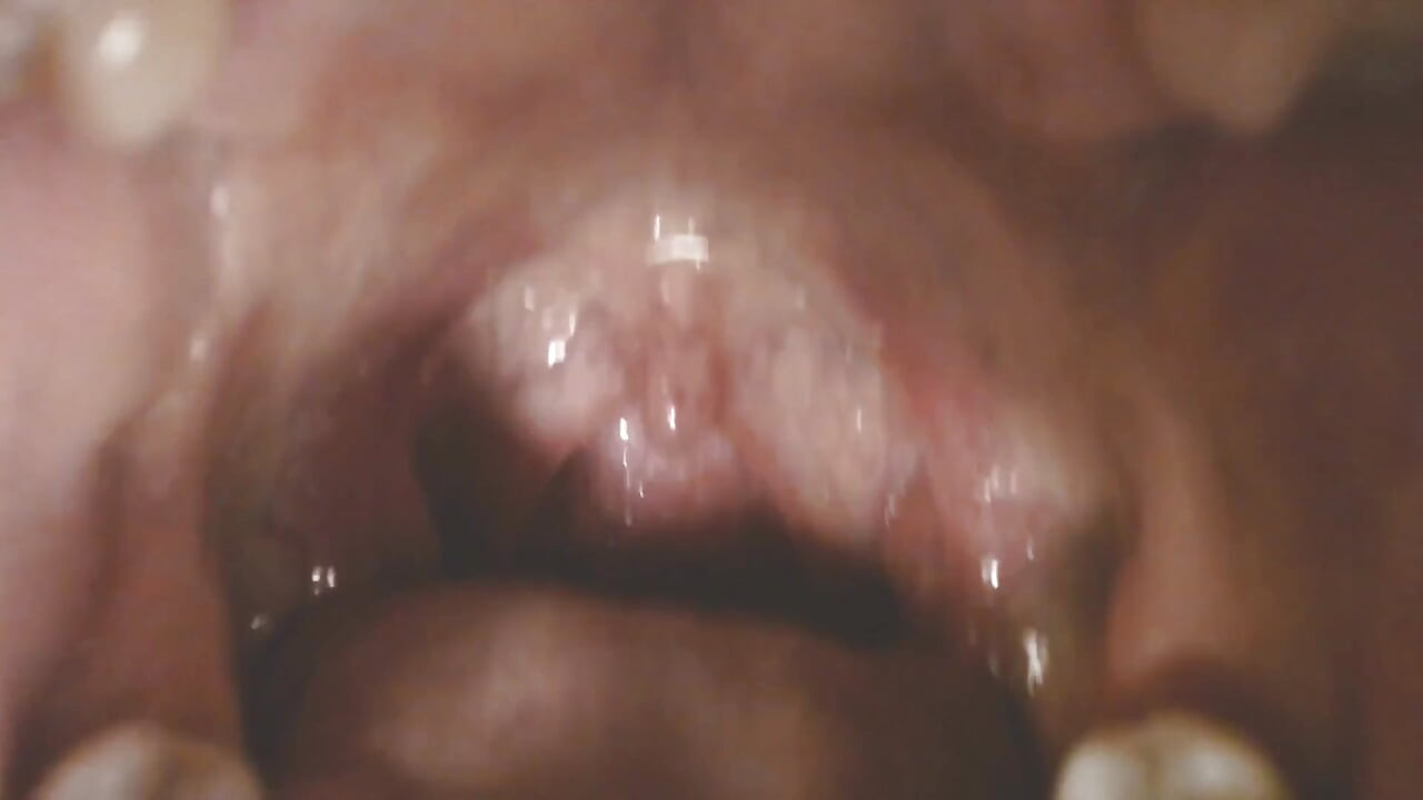 Hals und mund spucken Saiten, Uvula Mandeln uvula