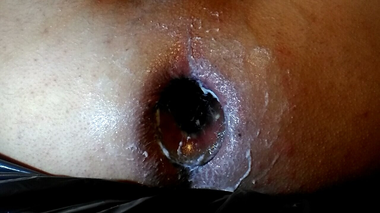 Dilatazione anale