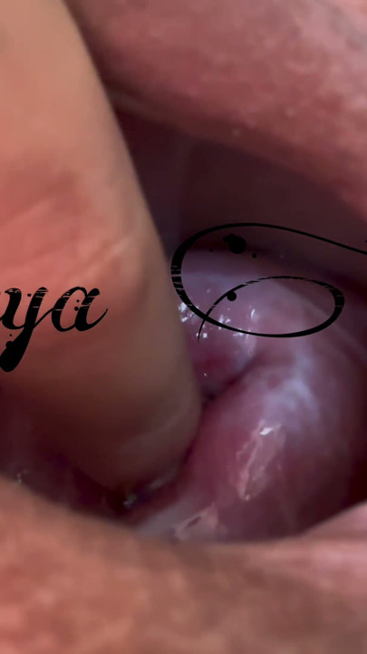 Small cervix without dilating | Clip 1