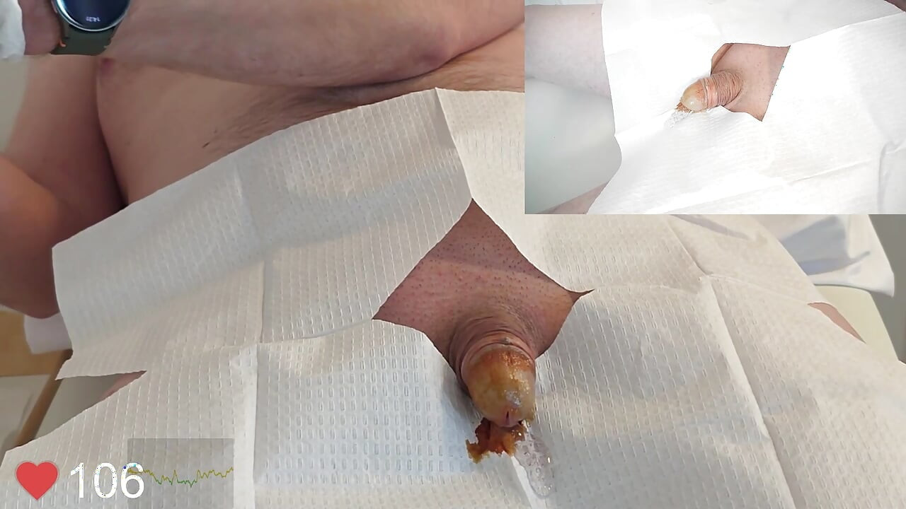Close-Up insertion of a 16 French foley catheter