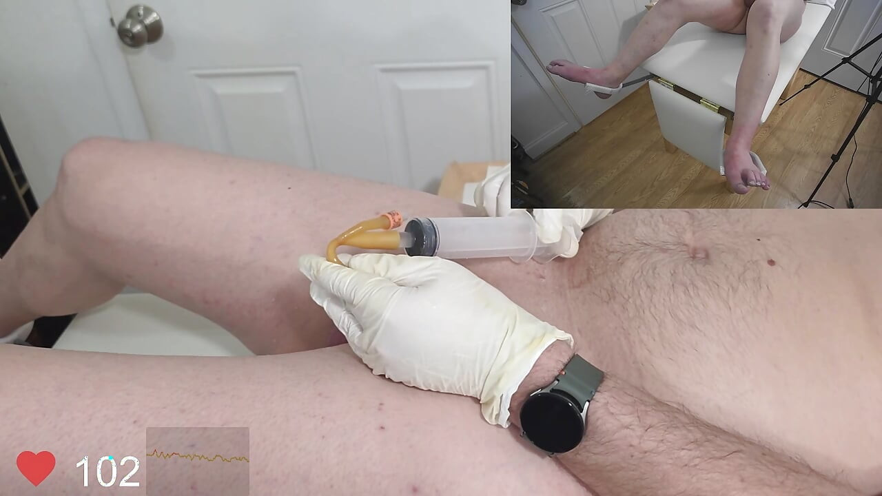 Foley Catheter and Bladder Filling