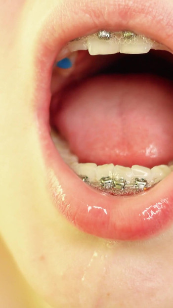 Spectacular moment from "braces mouth tour video - vore fetish"