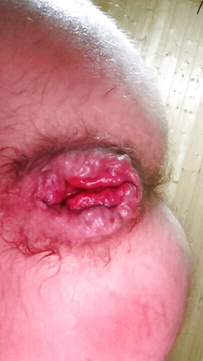 Anal Prolapse,Anal